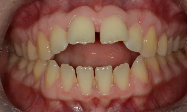 Case 3
Anterior Openbite

24 year old female with a severe anterior open bite, treated with a modified trans-palatal arch with a tongue guard and upper and lower radiance clear fixed appliances.
